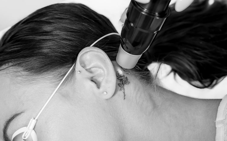 Usuwanie tatuażu za uchem